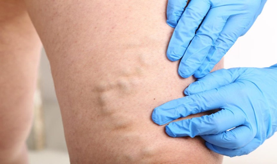 Полезные и вредные упражнения при борьбе с варикозом